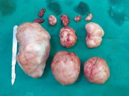 बच्चेदानी के ऑपरेशन के 6 महीने बाद मरीज का प्राकृतिक गर्भाधान है संभव