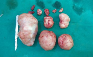 बच्चेदानी के ऑपरेशन के 6 महीने बाद मरीज का प्राकृतिक गर्भाधान है संभव