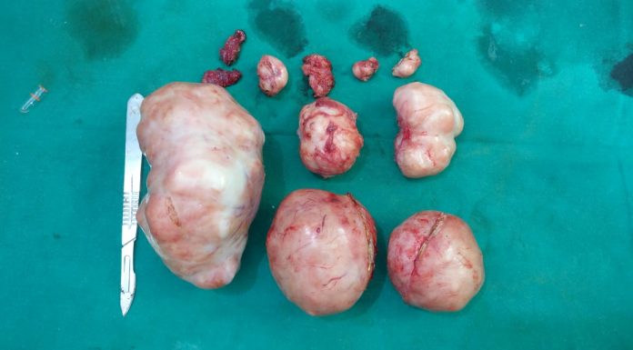 बच्चेदानी के ऑपरेशन के 6 महीने बाद मरीज का प्राकृतिक गर्भाधान है संभव